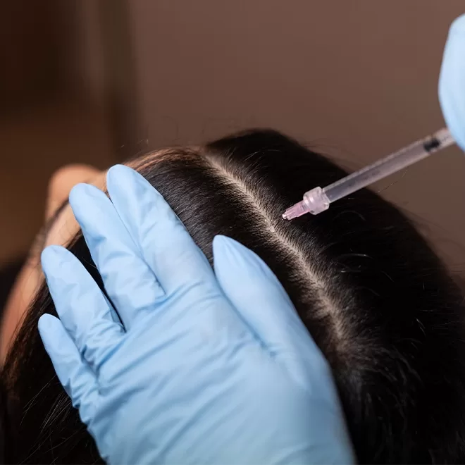 A person wearing blue gloves holds a section of dark hair, exposing the scalp, while injecting a syringe into the part line.